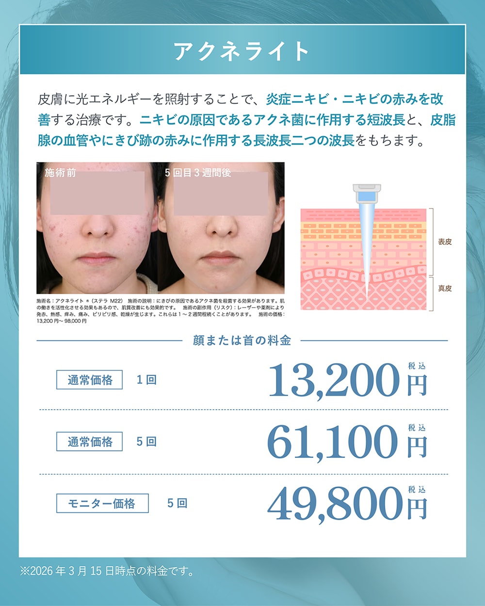 アクネライト l ニキビ・ニキビ跡の赤みに