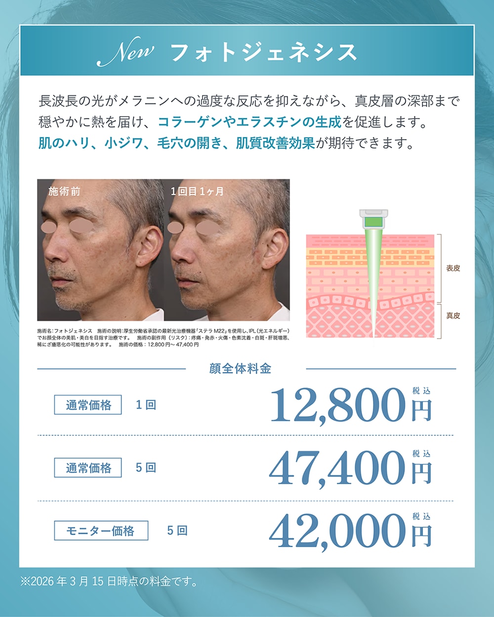 【NEW】フォトジェネシス l 毛穴・ハリ・小ジワを改善する肌育光治療