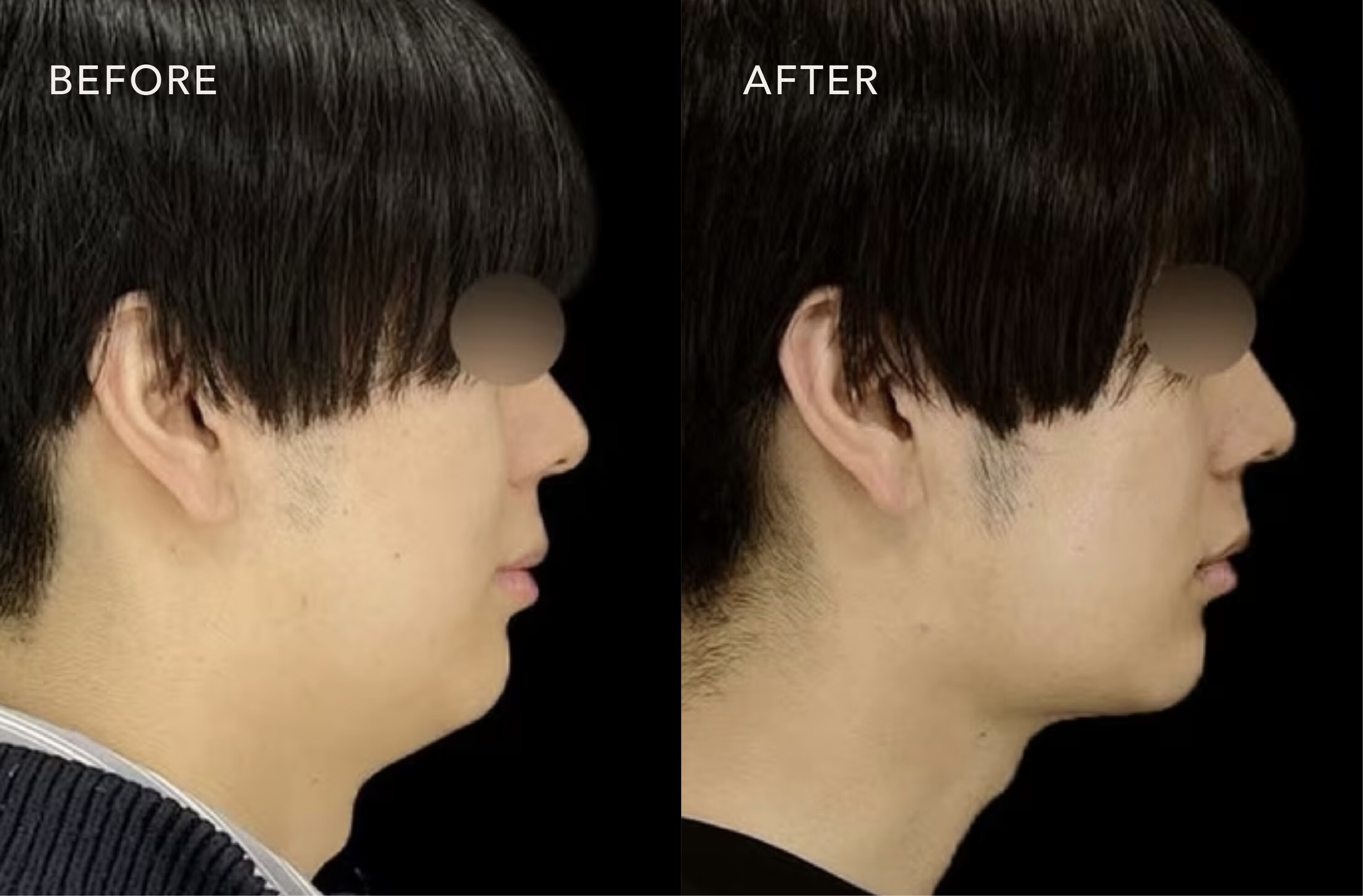 脂肪吸引がおすすめの男性