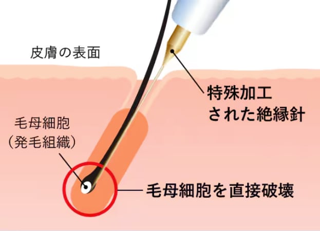 絶縁針を使用した医療ニードル脱毛