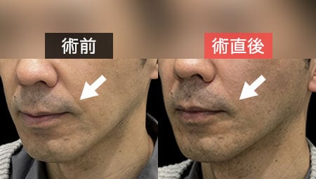 法令線・口元のもたつきが気になる方