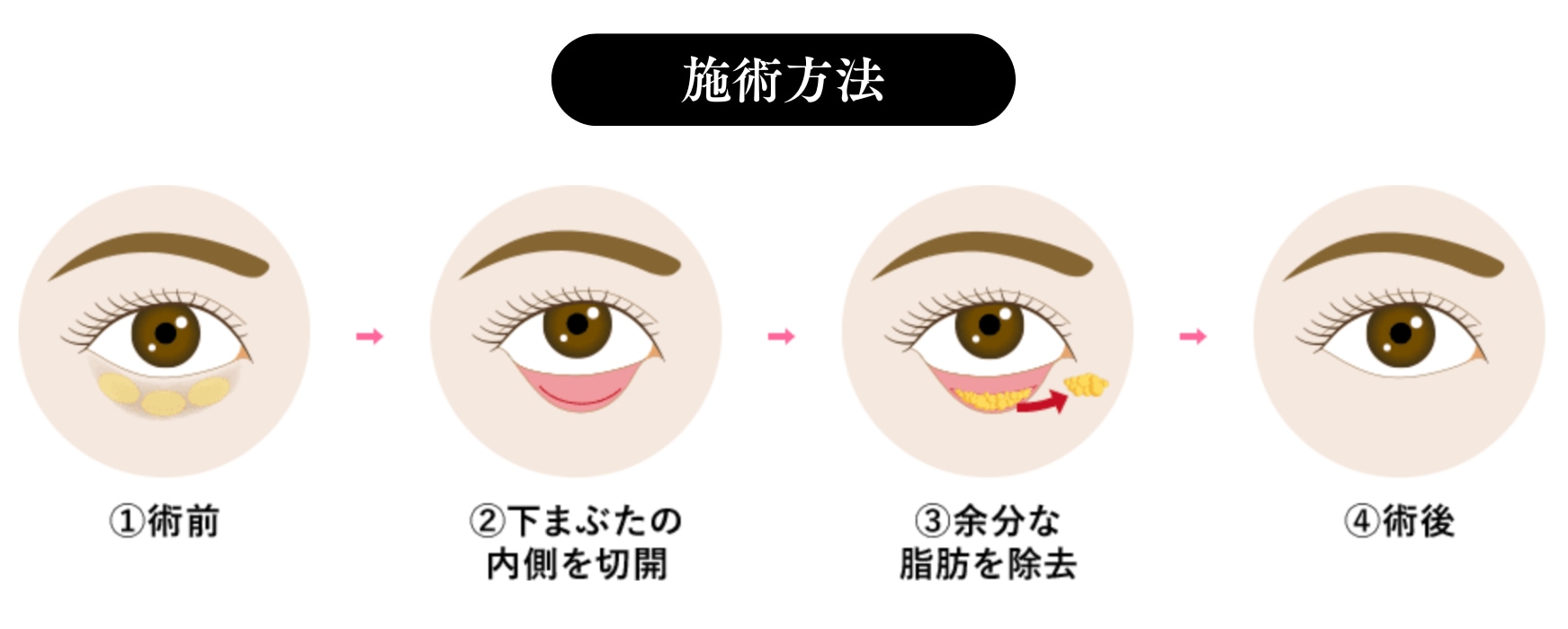 目の下の切らないクマ・たるみ（ふくらみ）取り