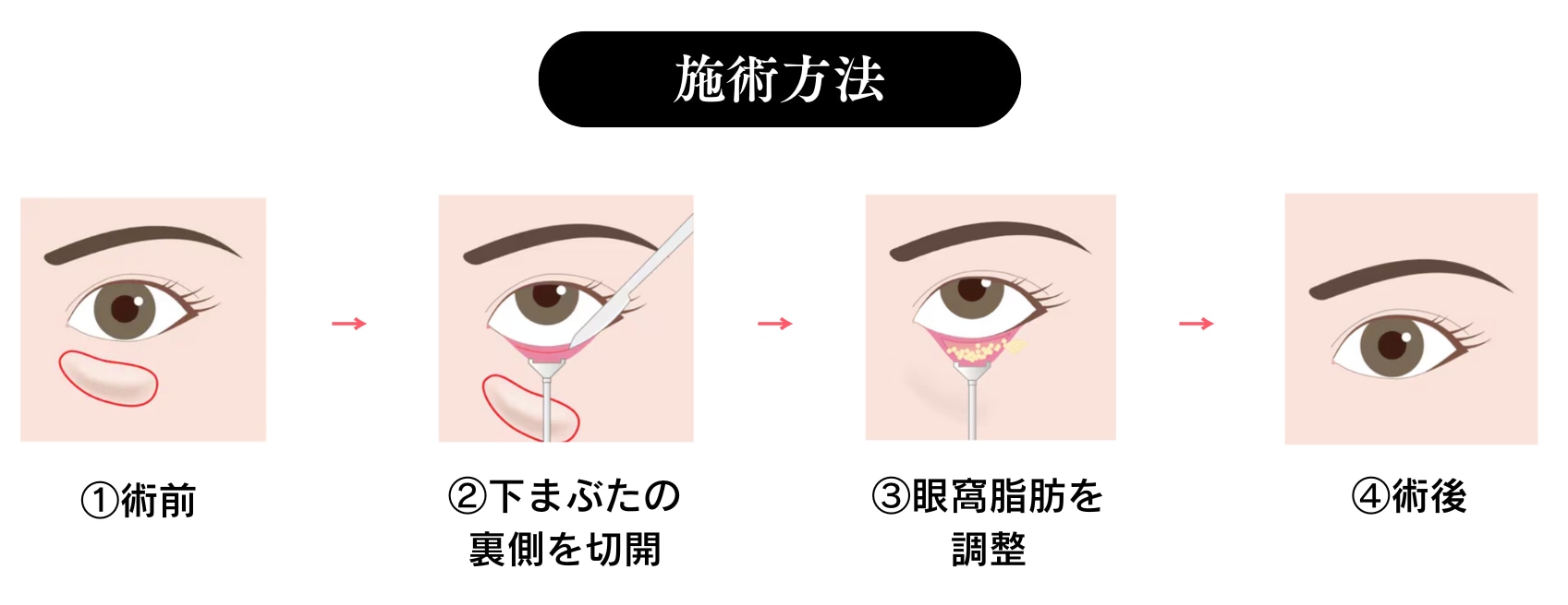 裏ハムラ法