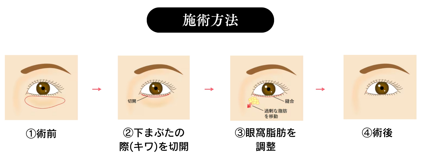 切開ハムラ法