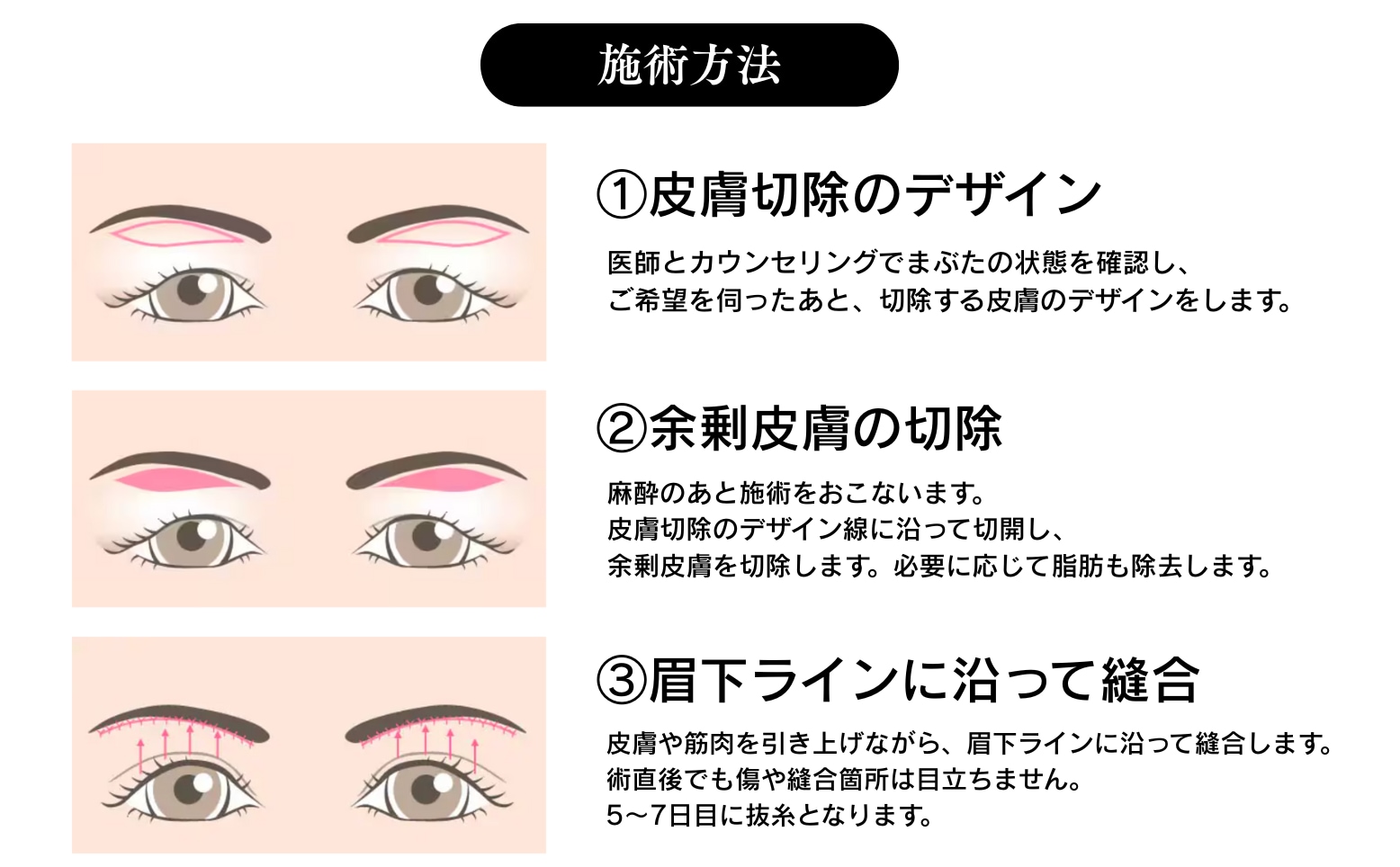 眉下切開ってなに？