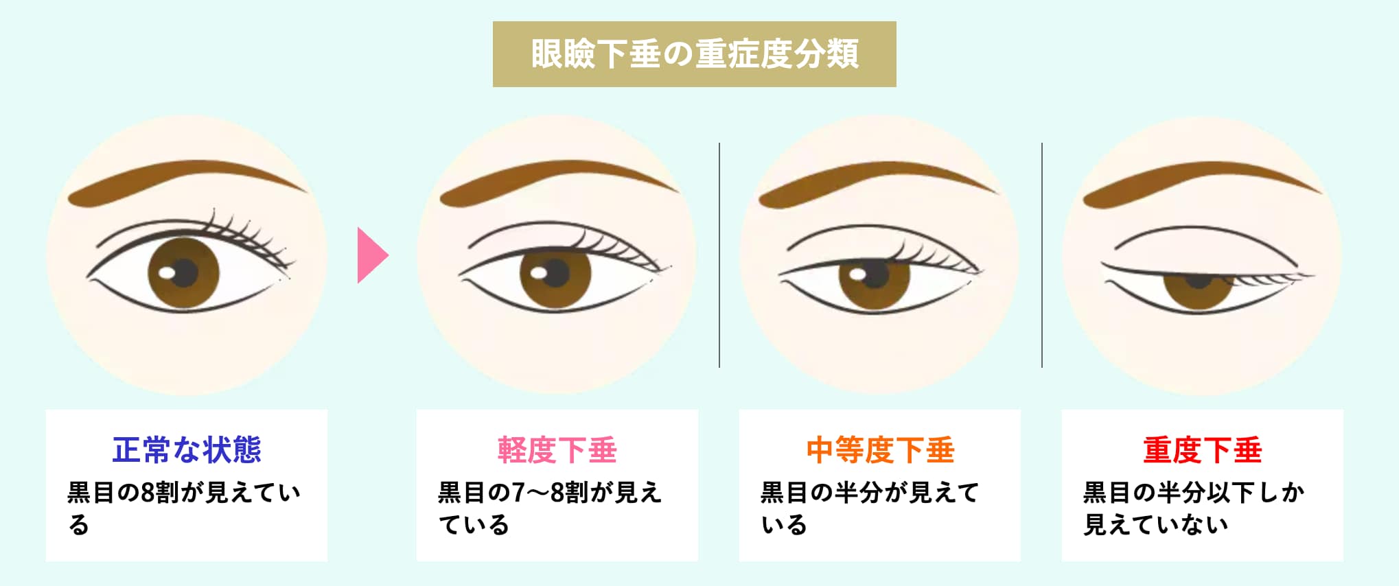 眼瞼下垂ってなに？