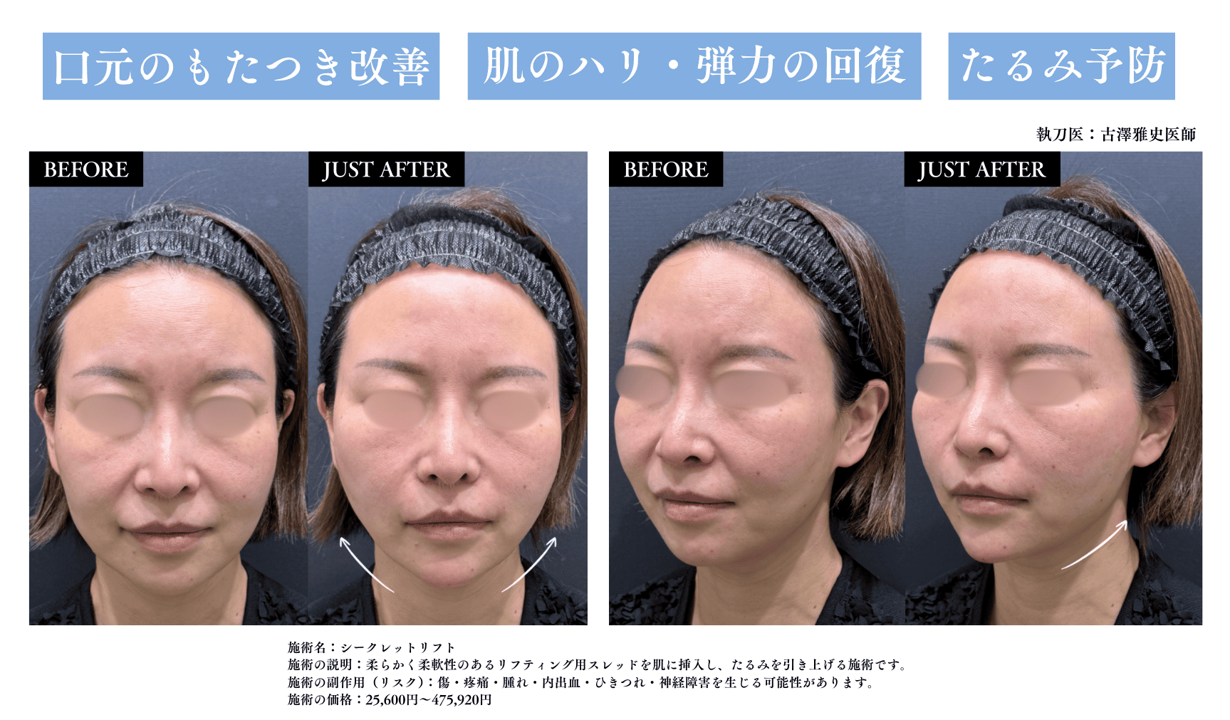 糸リフト