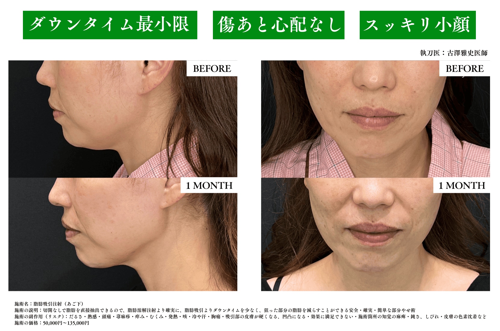 脂肪吸引