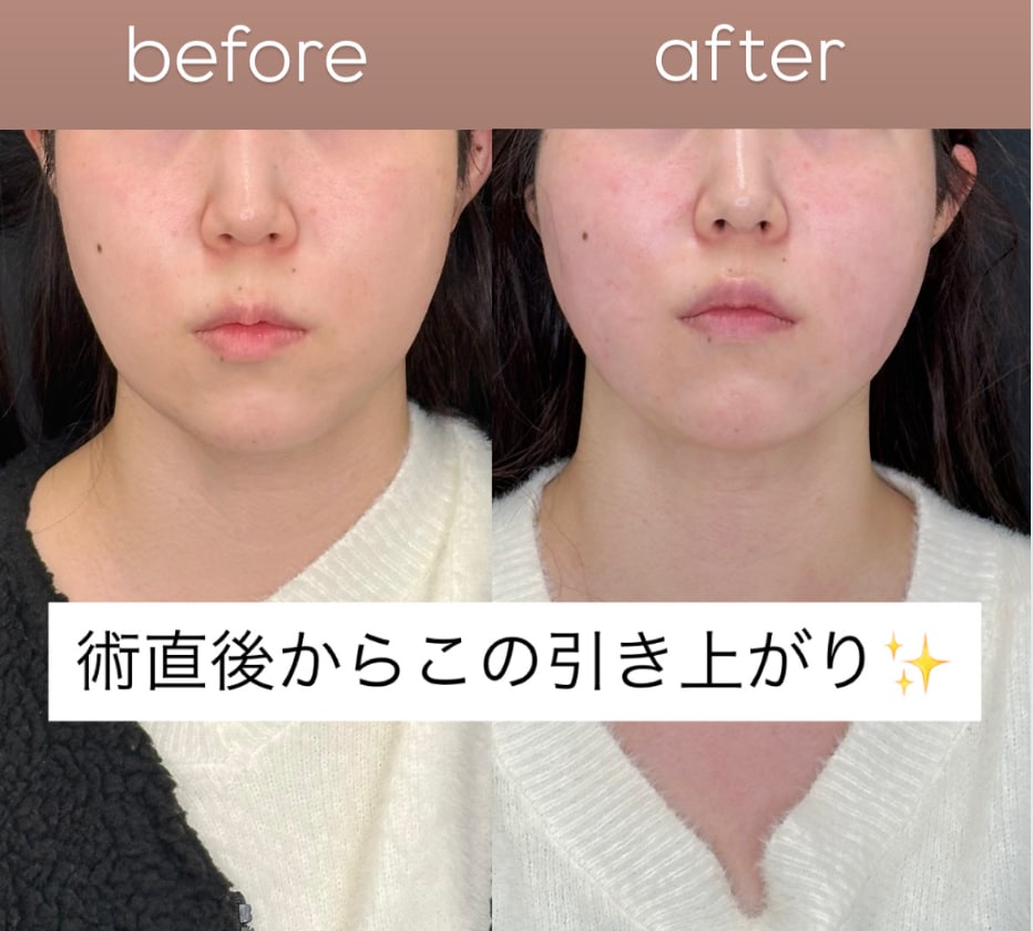 ビーナススレッドリフトプレミアム  12本