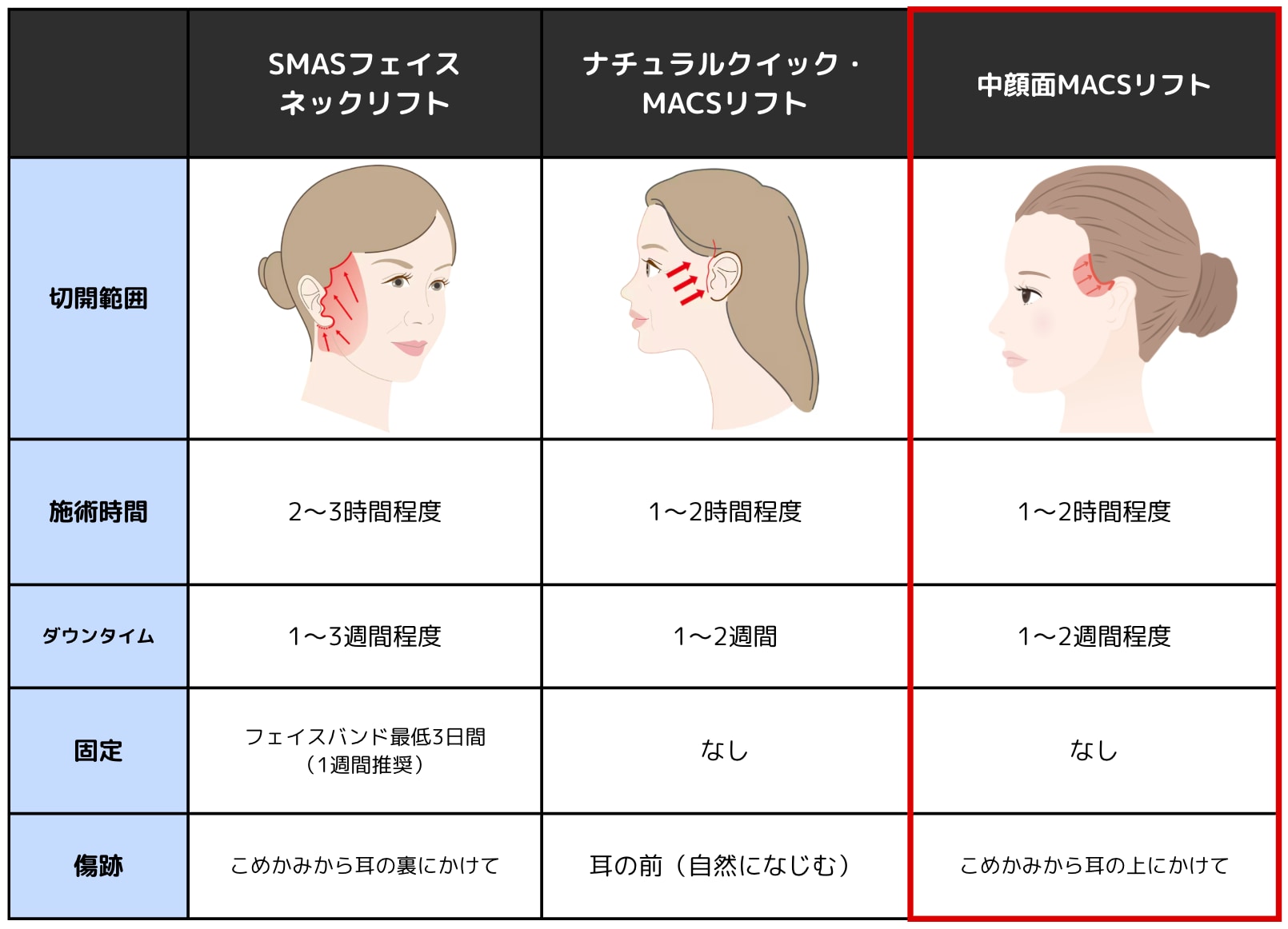 切開フェイスリフト徹底比較