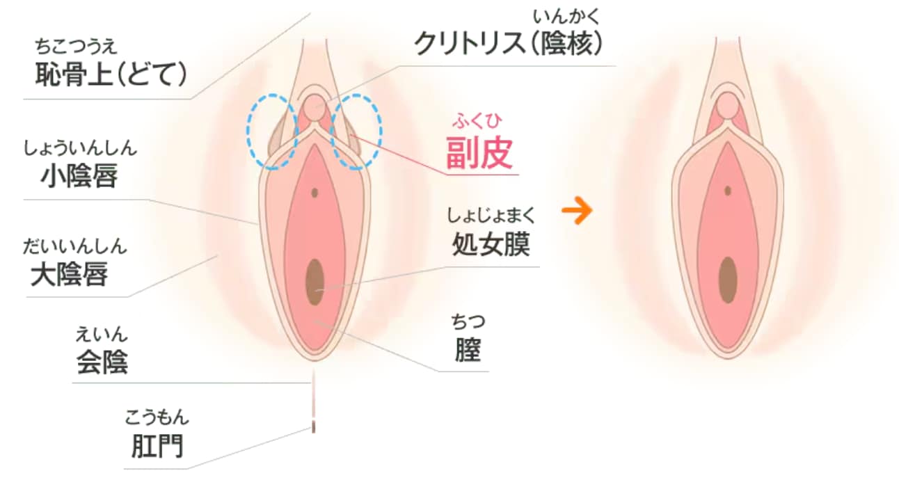 池袋で婦人科形成|副皮除去術