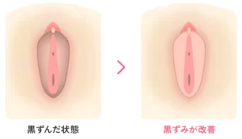 池袋で婦人科形成|デリケートゾーン黒ずみ解消レーザー