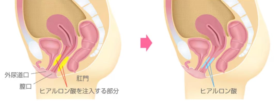 池袋で婦人科形成|プチ膣縮小(ヒアルロン酸注入)