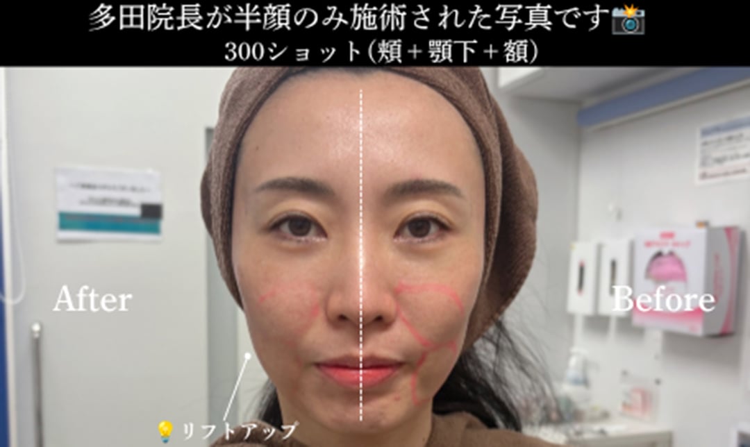 多田院長も実際に受けてみました✨<br />
