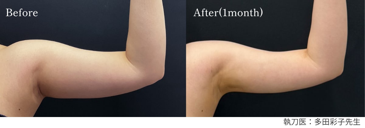 【脂肪吸引】理想のボディラインを最短で。リバウンドしにくい「部分痩せ」