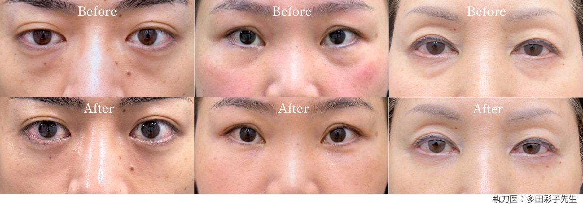 【目の下の切らないたるみ取り】「疲れ顔」とサヨナラ。