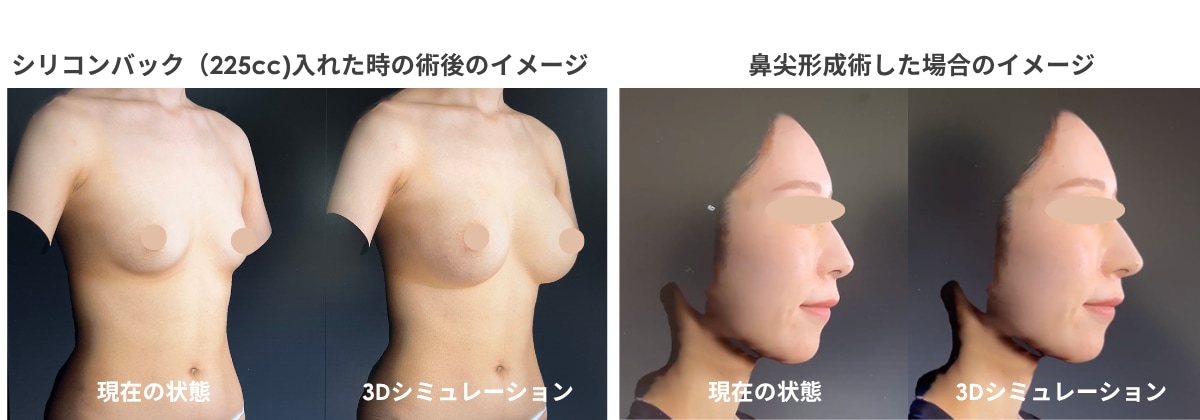 【鼻整形・豊胸】最新3Dシミュレーション「ベクトラ」導入