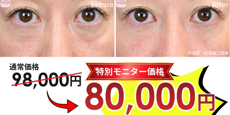 ベビーコラーゲン　症例　ビフォーアフター　