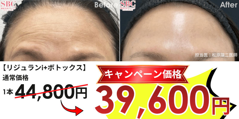 女優注射　リジュラン　症例写真　ビフォーアフター　しわ　ツヤ　池袋西口