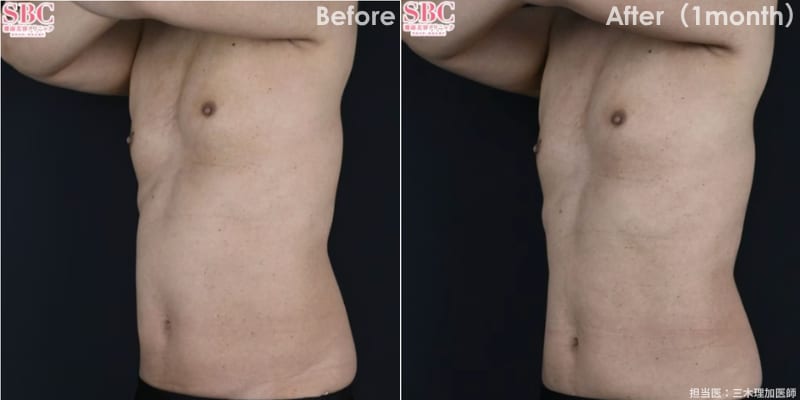 オンダリフト ボディ 症例 ビフォーアフター 痩身 ダイエット