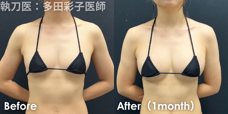 SBC 池袋西口院 豊胸 バストアップ 症例 ビフォーアフター