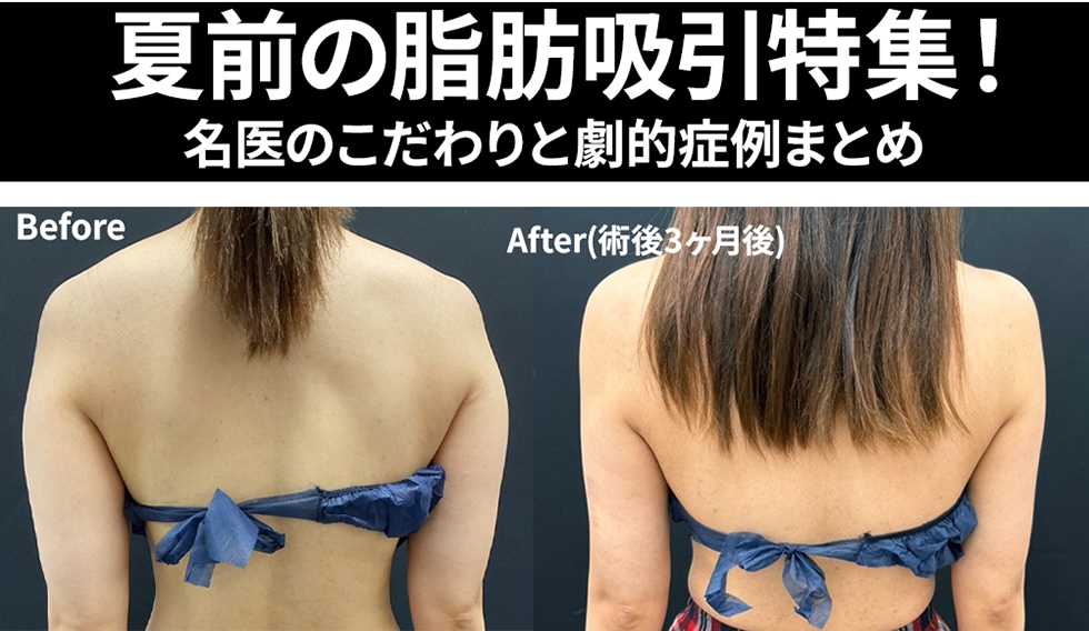【湘南池袋西口】夏前の脂肪吸引特集!名医のこだわりと劇的症例まとめ