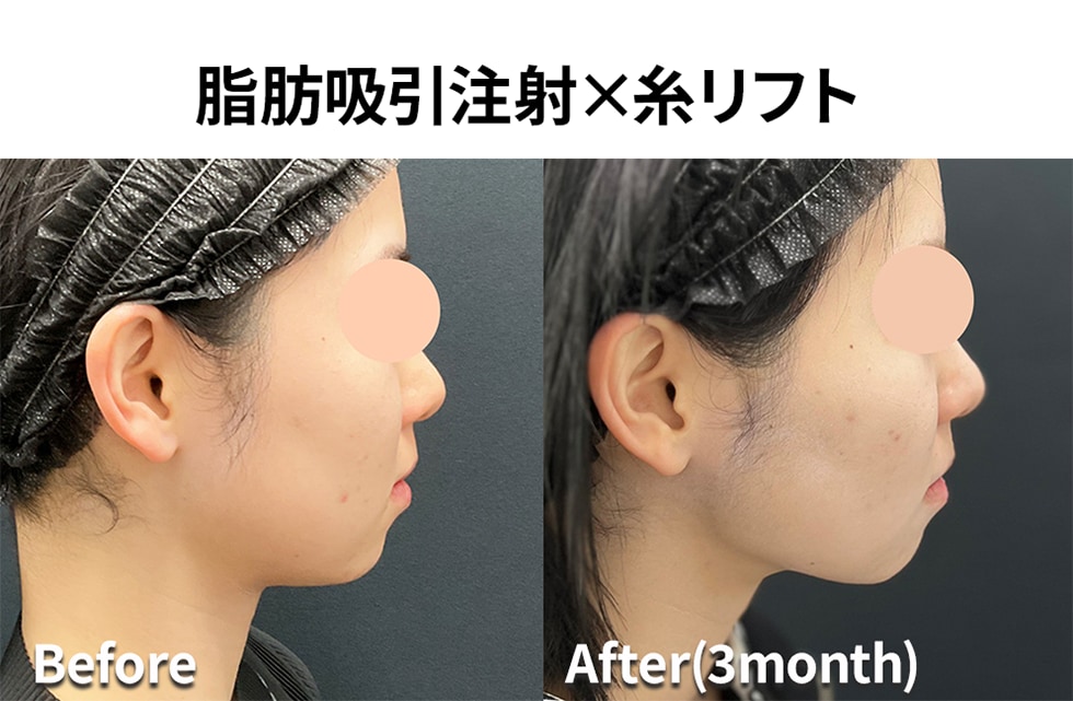 脂肪吸引注射💉