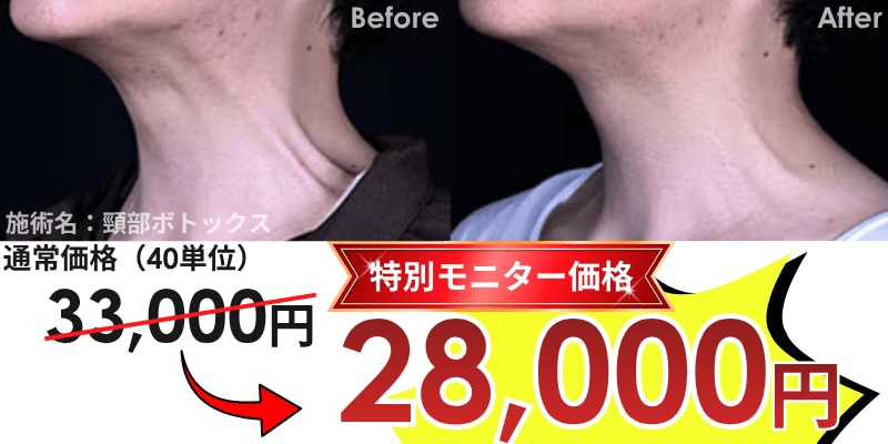 頸部ボトックス　池袋　症例写真　ビフォーアフター　安い　キャンペーン