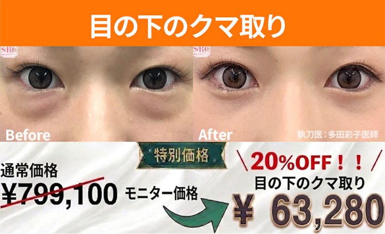 目の下のクマ取り