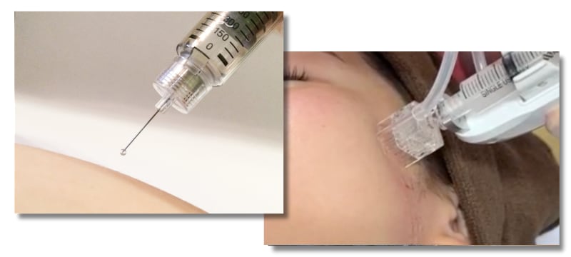 注入方法で効果が変わる？<br />
「手打ち」と「機械」の違い