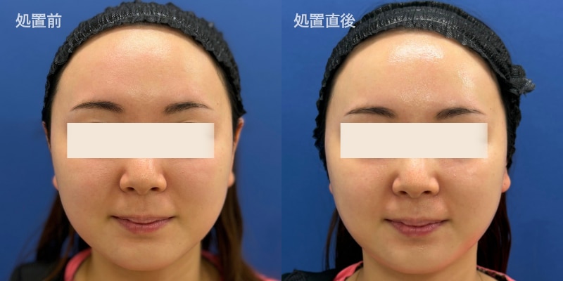 ララドクター 肌トーン くすみ 湘南美容 池袋 症例写真 ビフォーアフター