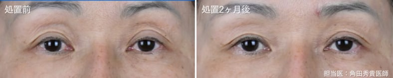 デンシティアイ たるみ 若返り 池袋症例写真 ビフォーアフター