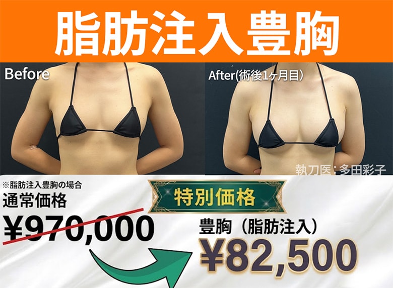 脂肪注入豊胸金額