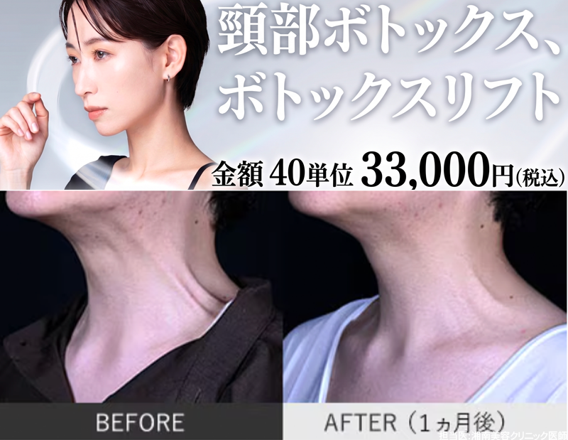 頸部ボトックス