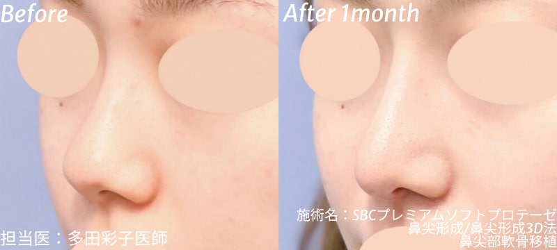 プロテーゼ 鼻尖部軟骨移植 鼻尖形成 症例写真 ビフォーアフター 処置前 処置1ヶ月後