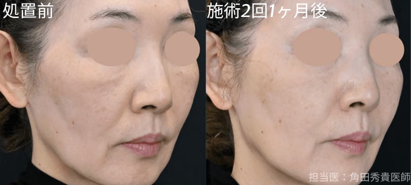 ジャルプロスーパーハイドロ　症例写真　ビフォーアフター　処置前　処置後　ほうれい線　たるみ　若返り
