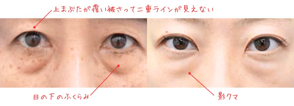 あなたの目元、こうなってない？