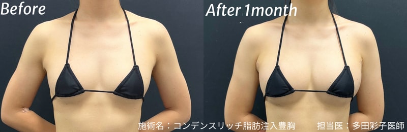 コンデンスリッチ脂肪注入豊胸 症例写真 ビフォーアフター 多田彩子医師