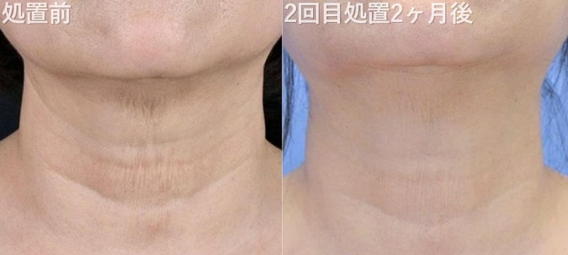 プロファイロ 若返り 注射 首のシワ 症例写真 ビフォーアフター 池袋 SBC