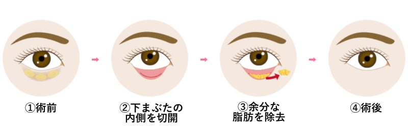切らないクマ取り（経結膜脱脂）解説図