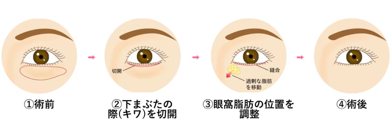 切開ハムラ法 解説図