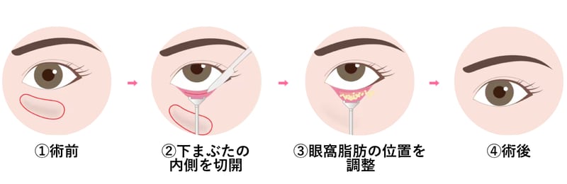 裏ハムラ法（脂肪再配置術）解説図