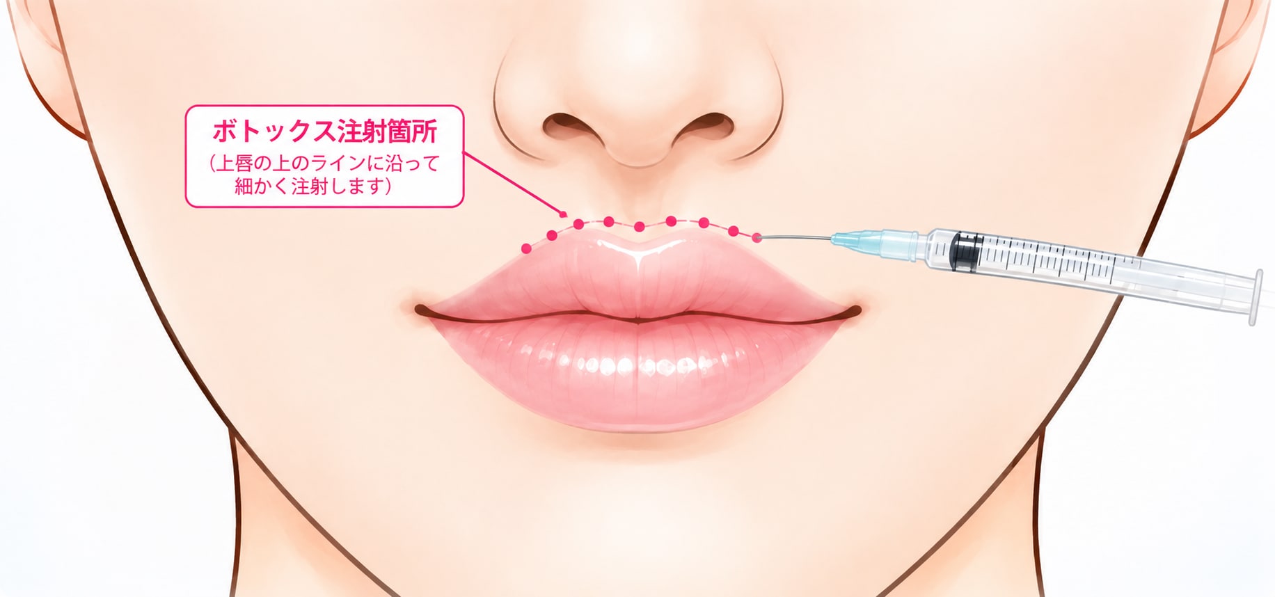池袋で切らない人中短縮ボトックス