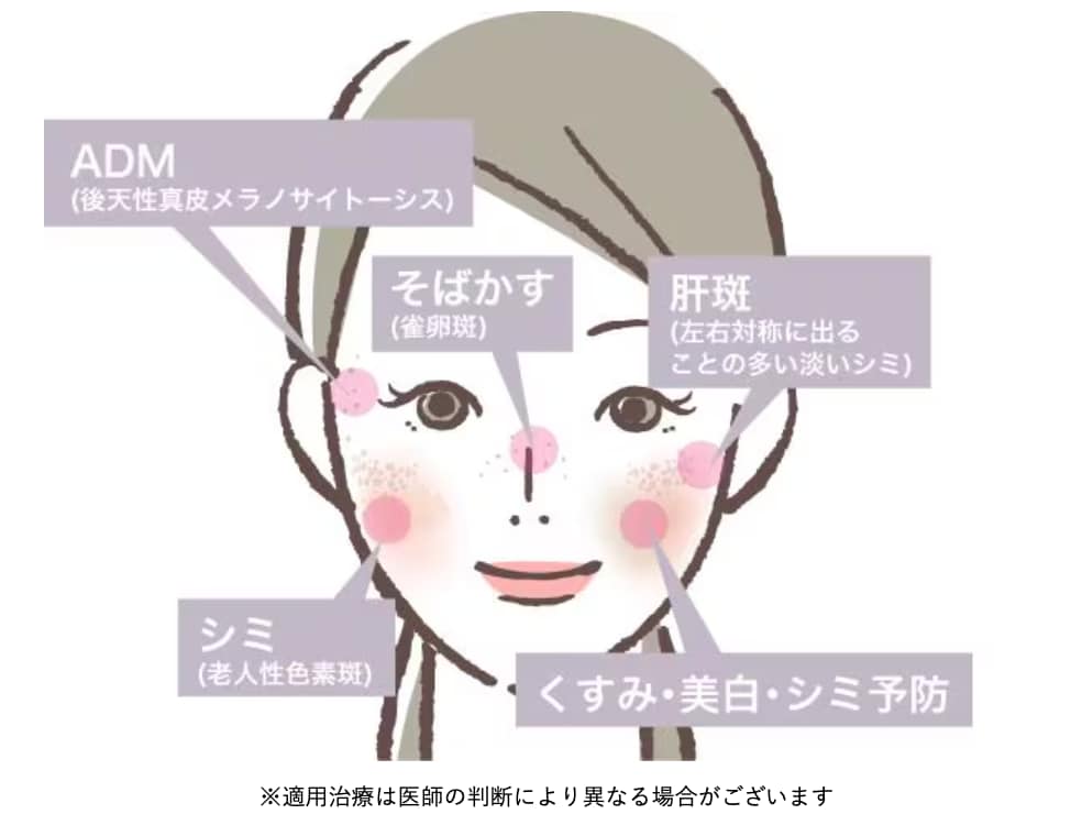 池袋でシミ取りなら湘南美容クリニック池袋西口院 シミの種類別の部位・診察案内イラスト
