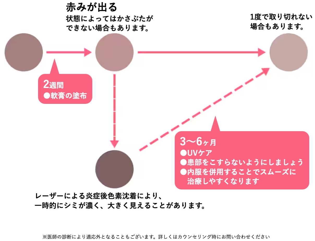 池袋でシミ取りなら湘南美容クリニック池袋西口院 シミ取り後の経過プロセスイラスト
