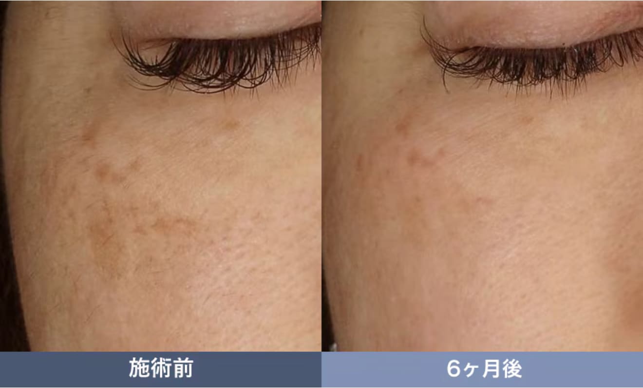 池袋でシミ取りなら湘南美容クリニック池袋西口院 レーザートーニング 症例写真
