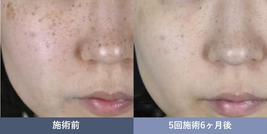池袋でシミ取りなら湘南美容クリニック池袋西口院 IPL光治療 症例写真
