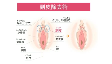 小陰唇(しょういんしん)縮小術との組み合わせ治療