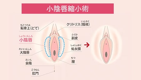 小陰唇(しょういんしん）縮小術でお悩みを解消！