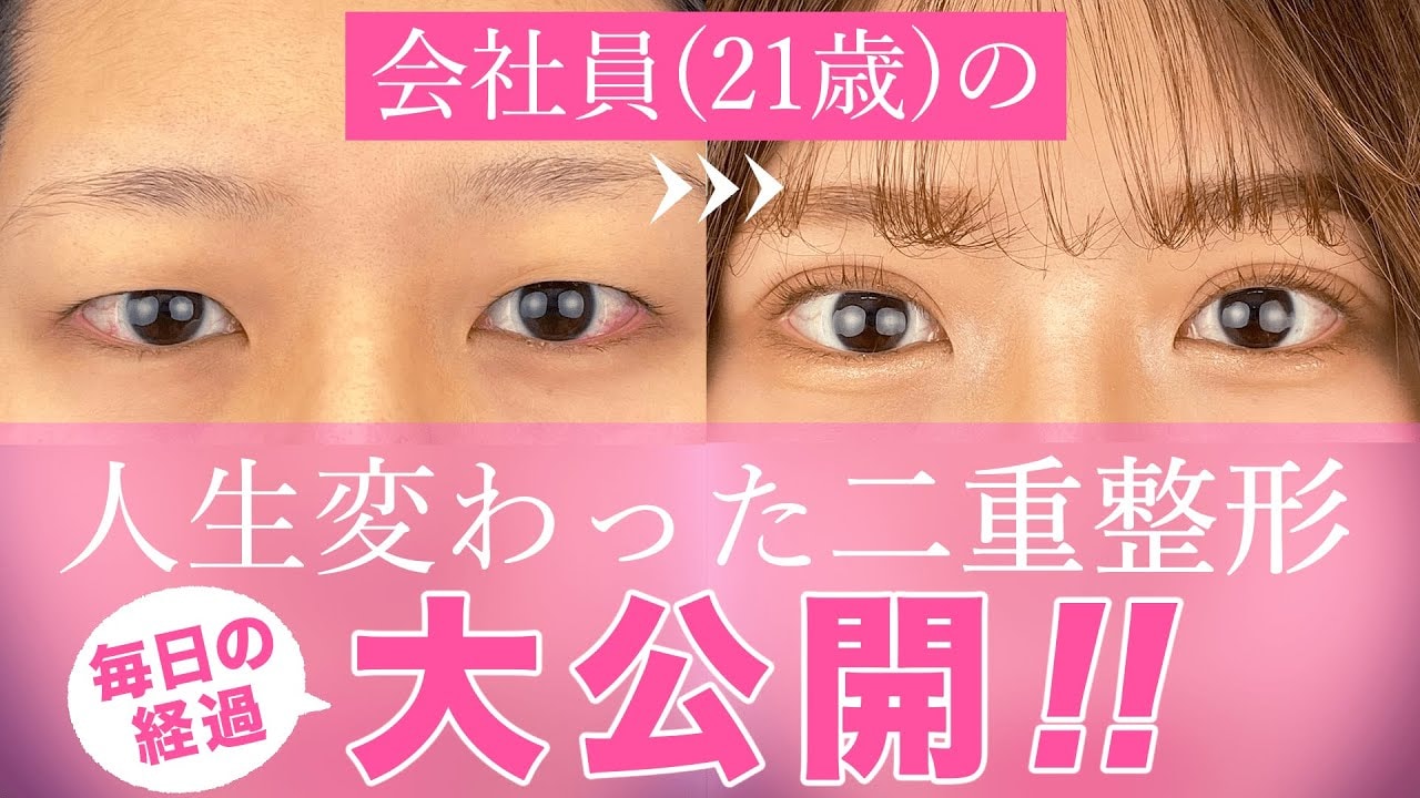 埋没法のダウンタイムのリアルな経過とは？術後2週間の記録！